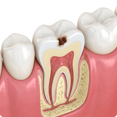 A small cavity is forming on the tooth surface.
