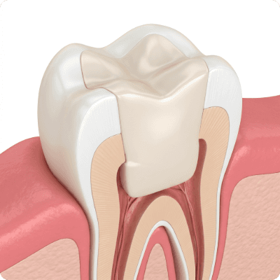 The decay is removed and filled with a durable composite.